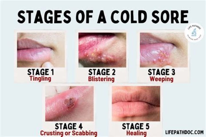 Popped a Cold Sore: Everything You Need to Know About Causes, Treatments, and Prevention