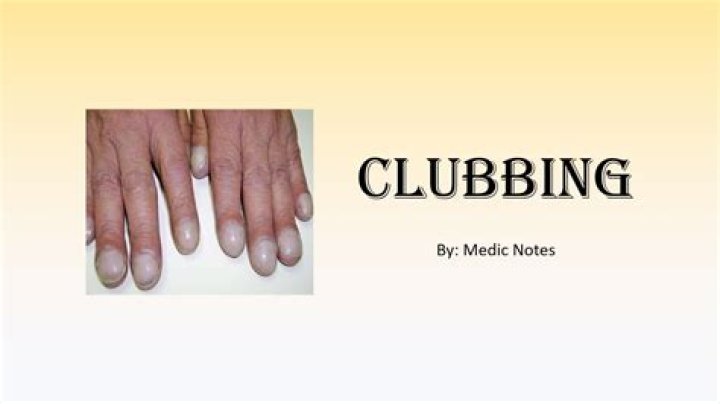 Understanding Clubitis Disease: Symptoms, Causes, Diagnosis, and Treatment